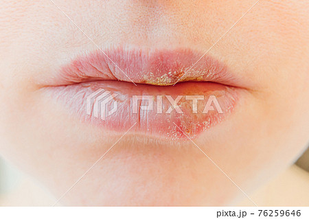 Close up of girl lips affected by herpes. Treatment of herpes infection and virus. Part of young woman face, lips with herpes affected. Beauty dermatology concept. Close up of girl lips affected by herpes. Treatment of herpes infection and virus. Part of young woman face, lips with herpes affected. Beauty dermatology concept. 76259646