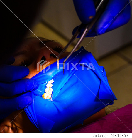 Treatment of the upper sixth left tooth, sterile treatment with roofing felt. Treatment of the upper sixth left tooth, sterile treatment with roofing felt. 76319358