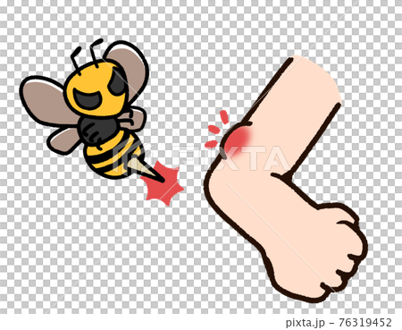 虫刺され 腕 ハチのイラスト素材 虫刺され 腕 ハチのイラスト素材