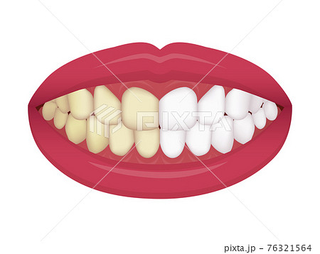 歯のホワイトニング 黄ばんだ歯と白い歯 ビフォアアフター ベクターイラスト のイラスト素材