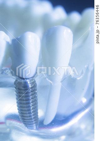 Dental tooth implant Dental tooth implant 76356446