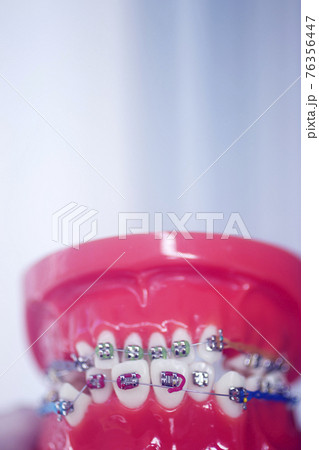 Dental teeth aligners brackets Dental teeth aligners brackets 76356447