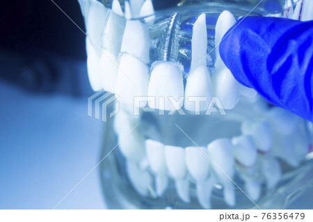 Dental tooth implant model Dental tooth implant model 76356479