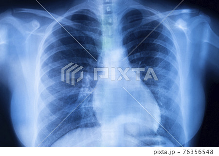 Lungs ribs xray scan 76356548