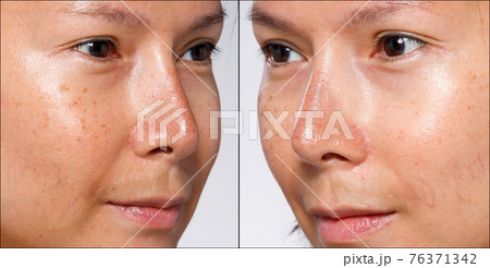 Close Up Nose which is Sunburned from Summer Sun 76371342