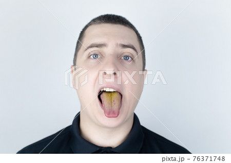 The man has a yellow tongue. Painful yellow coating on the mucous membrane of the tongue. Diseases of the gastrointestinal tract, liver and gallbladder. The consequences of taking antibiotics. The man has a yellow tongue. Painful yellow coating on the mucous membrane of the tongue. Diseases of the gastrointestinal tract, liver and gallbladder. The consequences of taking antibiotics. 76371748