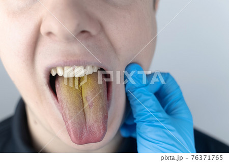 The man has a yellow tongue. Painful yellow coating on the mucous membrane of the tongue. Diseases of the gastrointestinal tract, liver and gallbladder. The consequences of taking antibiotics. 76371765