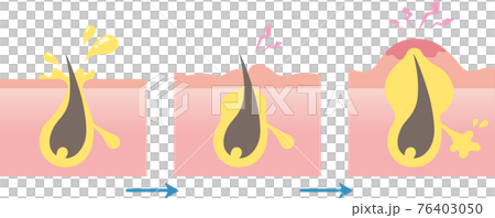 毛孔堵塞和粉刺的過程。皮脂分泌過多。皮膚問題。 76403050