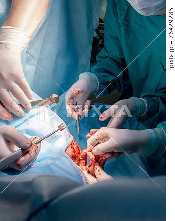 A surgical instrument in the bloodied hands of surgeons during a surgical operation. 76429285