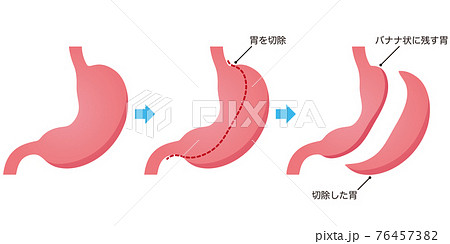 胃の縮小手術のイラスト素材