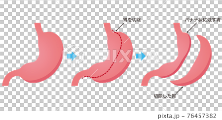 胃の縮小手術 76457382