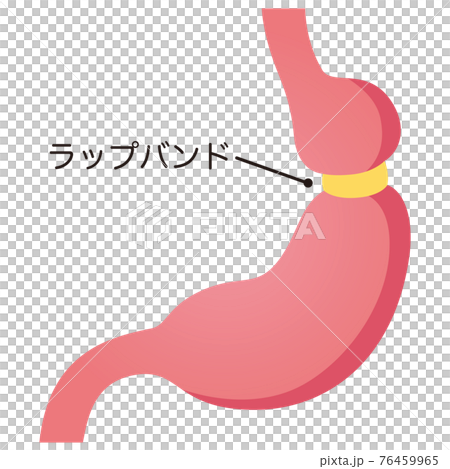 ラップバンドを巻いた胃のイラスト素材
