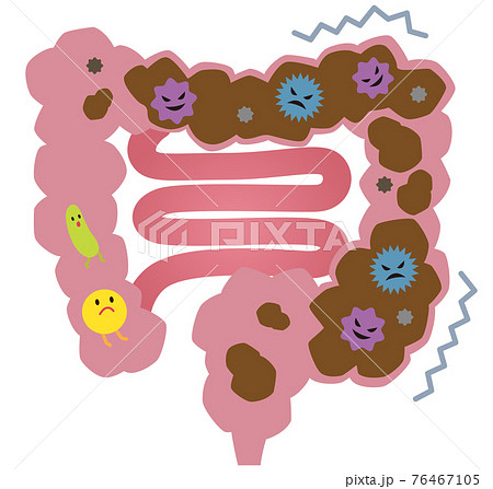 便秘の大腸 腸内環境 悪玉菌のイラスト素材