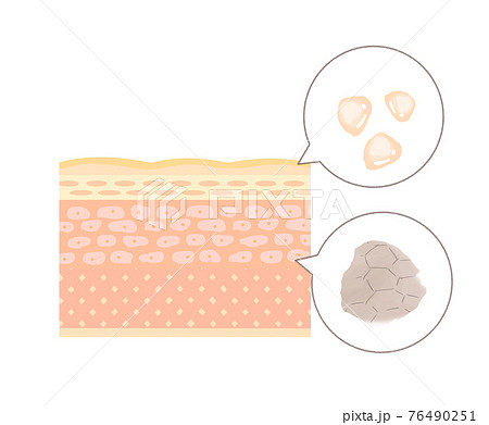 インナードライ肌のイメージ インナードライ肌のイメージ 76490251