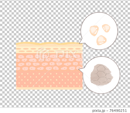 インナードライ肌のイメージ インナードライ肌のイメージ 76490251