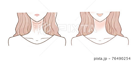 首のしわに悩む女性のビフォーアフター クローズアップのイラスト素材