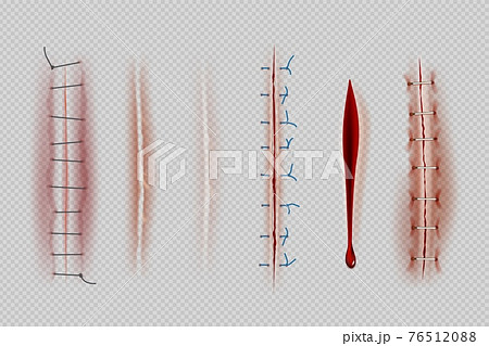 Surgical sutures. Medical closeup stitches scars and wounds decent vector realistic illustrations Surgical sutures. Medical closeup stitches scars and wounds decent vector realistic illustrations 76512088