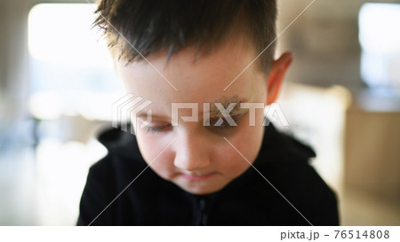 Poor sad small boy with cut eyebrow standing indoors at home, poverty concept. 76514808