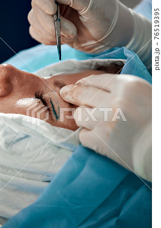 Close up of the face of a patient undergoing blepharoplasty. The surgeon cuts the eyelid and performs manipulations using medical instruments 76519395