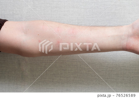 Male hand with positive allergy tests. Allergy tests on the arm 76526589