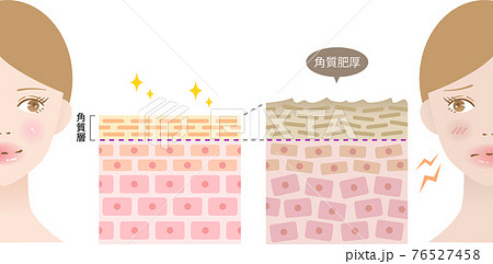角質肥厚　健康な肌　断面図と女性 76527458