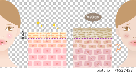 角質肥厚　健康な肌　断面図と女性 76527458
