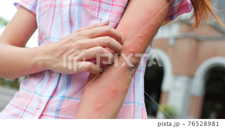 Bitten by mosquito in summer Bitten by mosquito in summer 76528981