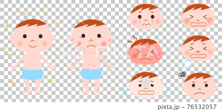 赤ちゃんとアレルギー症状のイラストセット 76532057