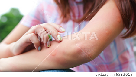 Bitten by mosquito in summer Bitten by mosquito in summer 76533015