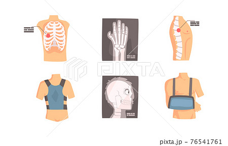 Bone Fractures Set, Medical Examination and Treatment of Back and Spine Injuries Cartoon Vector Illustration 76541761