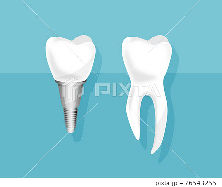 インプラントと健康な歯のイラストのイラスト素材