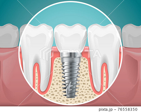 Stomatology illustrations. Dental implants and healthy teeth 76558350