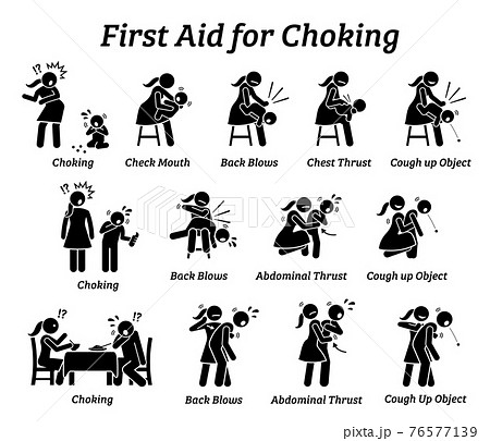 First aid emergency treatment for choking stick figures icon. Vector illustrations of baby, child, and adult choking while getting rescued with Heimlich Maneuver method. 76577139
