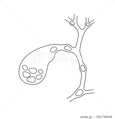 Variants of the location of stones in the gallbladder and bile ducts. Schematic drawing for cholelithiasis, gallstone disease. 76578698