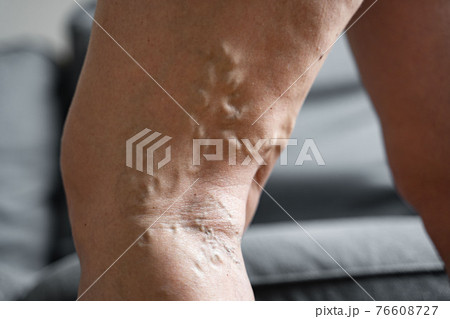 Varicose vein close up leg. Senior woman health problem. Foot with Diseased Veins. Health Care 76608727