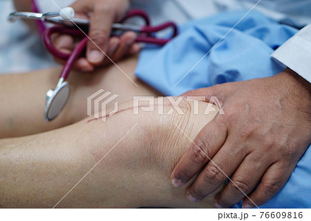 Asian senior or elderly old lady woman patient show her scars surgical total knee joint replacement Suture wound surgery arthroplasty on bed in nursing hospital ward Asian senior or elderly old lady woman patient show her scars surgical total knee joint replacement Suture wound surgery arthroplasty on bed in nursing hospital ward 76609816