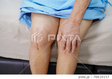 Asian senior or elderly old lady woman patient show her scars surgical total knee joint replacement Suture wound surgery arthroplasty on bed in nursing hospital ward Asian senior or elderly old lady woman patient show her scars surgical total knee joint replacement Suture wound surgery arthroplasty on bed in nursing hospital ward 76610157