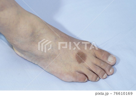Dermatitis foot have a dark, circular appearance. Dermatitis foot have a dark, circular appearance. 76610169