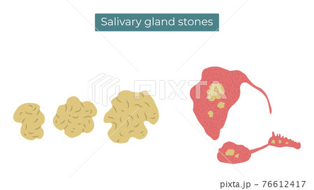Vector flat illustration of stones in the parotid, submandibular and sublingual salivary glands. 76612417
