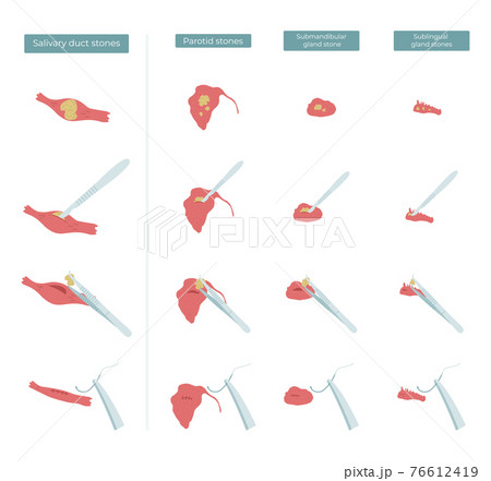 Vector flat illustration of surgery to remove stones from the parotid, submandibular and sublingual salivary glands. Vector flat illustration of surgery to remove stones from the parotid, submandibular and sublingual salivary glands. 76612419