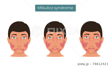 Vector illustration of Mikulicz syndrome. Enlargement of the lacrimal and salivary glands. Vector illustration of Mikulicz syndrome. Enlargement of the lacrimal and salivary glands. 76612421