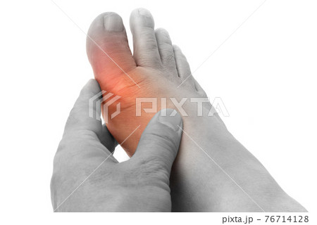 痛風症状の足の親指 76714128
