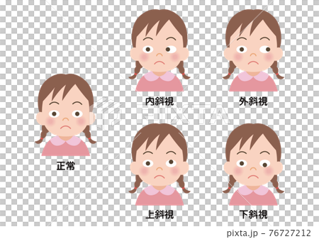 Illustration of a squint girl 76727212