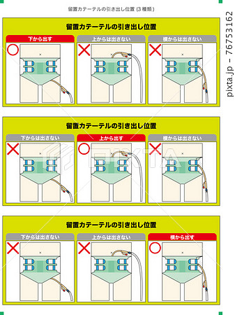 医療 おむつ装着時の 留置カテーテルの引き出し位置 Bのイラスト素材 医療 おむつ装着時の 留置カテーテルの引き出し位置 Bのイラスト素材