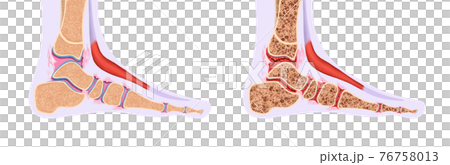 Anatomy of a healthy ankle and ankle disease 76758013