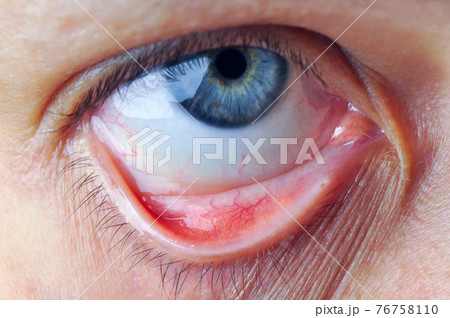 Eye and conjunctival sac. 76758110