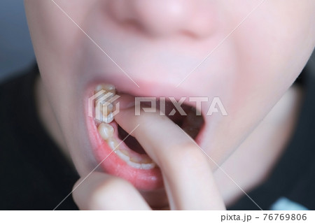 Baby tooth in mouth of a ten-year-old boy he sways it with his finger, closeup. Baby tooth in mouth of a ten-year-old boy he sways it with his finger, closeup. 76769806