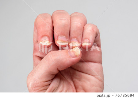 Onychomycosis or fungal nail infection on damaged nails after gel polish, onychosis. Longitudinal ridging nails with psoriasis, nail diseases. Health and beauty problem Onychomycosis or fungal nail infection on damaged nails after gel polish, onychosis. Longitudinal ridging nails with psoriasis, nail diseases. Health and beauty problem 76785694