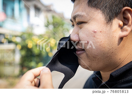 Asian man with acne on the face caused by wearing cloth face mask,bacteria from sweat,skin inflammation,young male have pimples,allergic,skin allergy from put a face mask,problems of inflamed acne 76805813