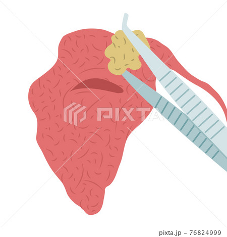 Vector illustration of removing a stone from the parotid salivary gland. Sialolithiasis Vector illustration of removing a stone from the parotid salivary gland. Sialolithiasis 76824999
